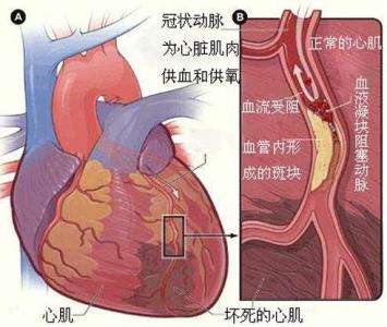 心肌梗死的临床表现 心肌梗死的临床表现 心肌梗死有哪些临床特征