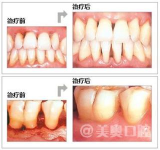 牙结石导致牙龈出血 牙龈出血是什么原因 导致牙出血的11个因素