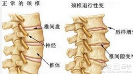 年轻人骨质增生 骨质增生的原因 小心骨质增生盯上年轻人