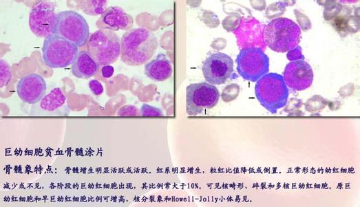 巨幼细胞性贫血 巨幼细胞性贫血 巨幼细胞性贫血-疾病概述，巨幼细胞性贫血-流行