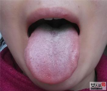 舌苔厚白吃什么中成药 舌苔厚白是怎么回事