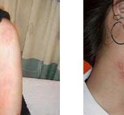 植皮手术后皮肤图 植皮 植皮-植皮工艺，植皮-皮肤移植
