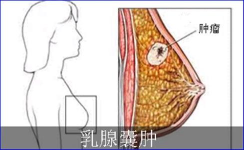 乳腺囊肿是什么原因 乳腺囊肿是什么 教你如何防治乳腺囊肿