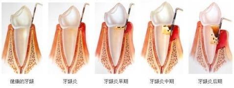 急性牙周炎治疗方法 牙周炎治疗方法