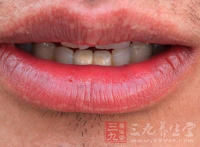 口唇疱疹的症状图片 唇疱疹 唇疱疹-病因，唇疱疹-症状
