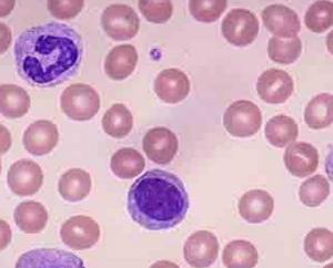 慢性粒细胞白血病原因 慢性粒细胞白血病 慢性粒细胞白血病-发病原因，慢性粒细胞白血病