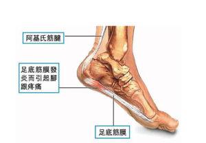 脚后筋疼是怎么回事 什么是足底筋膜炎？