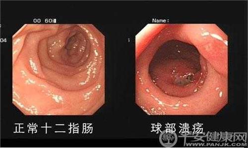 胃癌的早期症状 十二指肠溃疡症状