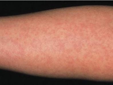 风疹的症状和治疗 什么是风疹 风疹的症状与治疗