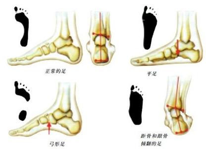 扁平足有什么危害 百科全说 扁平足的危害