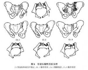 骨盆骨折的治疗 骨盆骨折的治疗 骨盆骨折的3个处理方法