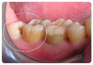 牙痛牙龈肿痛怎么办 长智齿牙龈肿痛怎么办 治疗牙痛的方法