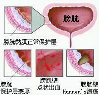 慢性膀胱炎的症状 慢性膀胱炎有哪些症状？