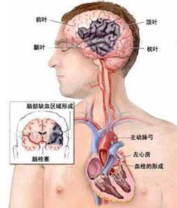 腔隙性脑梗塞症状 腔隙性脑梗塞的症状 腔隙性脑梗塞有哪些症状