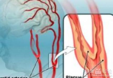 颈动脉硬化症状 颈动脉硬化的症状 了解何为颈动脉硬化