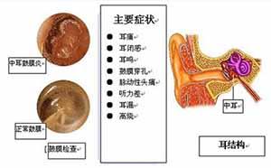 韭菜治疗中耳炎的偏方 中耳炎症状和治疗