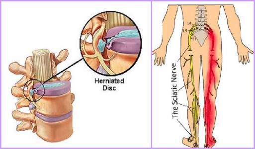 治腰椎盘突出的好方法 如何治疗腰椎盘突出