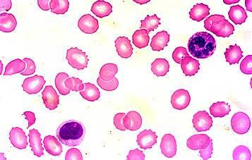 棘细胞癌 棘细胞 棘细胞-介绍，棘细胞-棘细胞癌