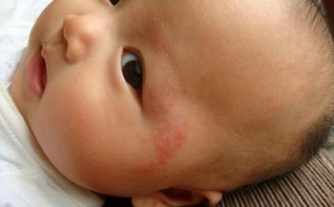 一个月宝宝湿疹怎么办 宝宝出湿疹怎么办