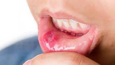 口腔溃疡临床表现 口腔溃疡 口腔溃疡-病因，口腔溃疡-临床表现
