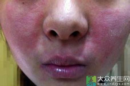 治疗脸部过敏的方法 脸上皮肤过敏的治疗方法