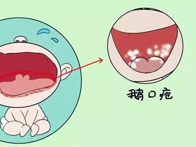 鹅口疮图片 什么是鹅口疮