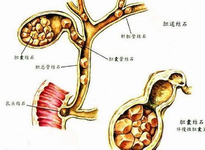 肝内胆管结石会自愈吗 肝内胆管结石的症状