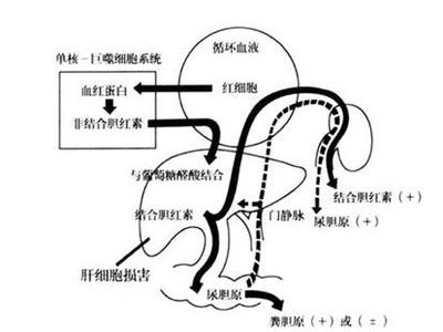 黄疸型肝炎的症状 黄疸型肝炎 黄疸型肝炎-【概述】，黄疸型肝炎-黄疸肝炎