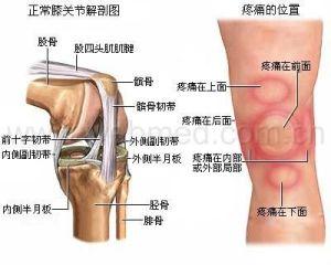 半月板损伤如何恢复 膝盖半月板损伤怎么办