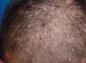 头皮毛囊炎症状图片 头皮毛囊炎是怎么引起的 头皮毛囊炎的症状与治疗