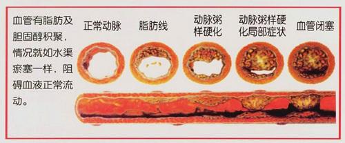 动脉硬化病因 动脉硬化的原因 9个动脉硬化的病因