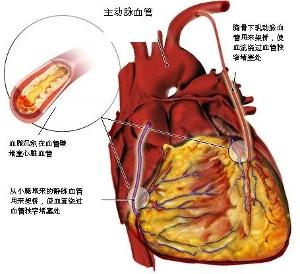 心肌缺血吃什么食物补 心肌缺血吃什么食物好