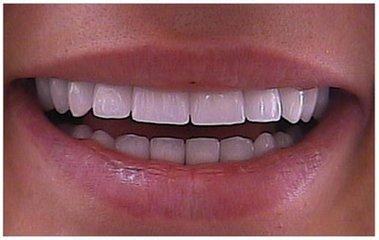 牙套类型价格表 牙套的种类详解