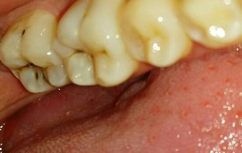 牙齿洗白有什么危害 牙齿可以洗白吗