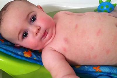 新生儿湿疹症状和护理 宝宝湿疹最佳治疗方法