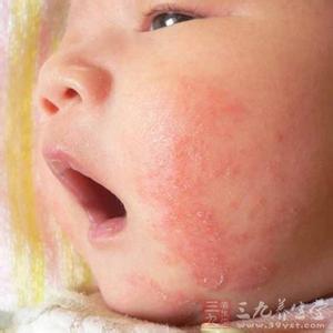 宝宝湿疹吃什么好得快 宝宝脸上长湿疹怎么办 怎样吃好得快