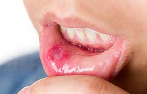 口腔溃疡的治疗方法 口腔溃疡怎么办 治疗口腔溃疡的妙法