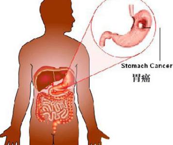 胃癌的症状及治疗 胃癌的症状 怎样有效治疗胃癌