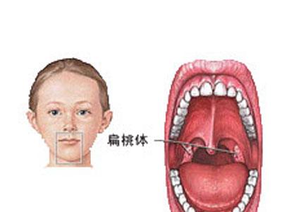 小孩扁桃体炎怎么治 扁桃体炎怎么办