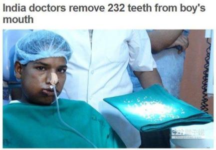 牙瘤 [图文]17岁印度少年患罕见牙瘤病 牙医拔232颗“牙齿”