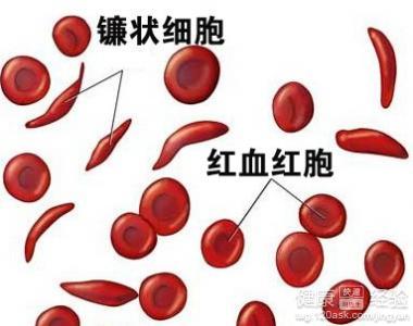 缺铁性贫血的治疗 缺铁性贫血的治疗 快速治疗缺铁性贫血