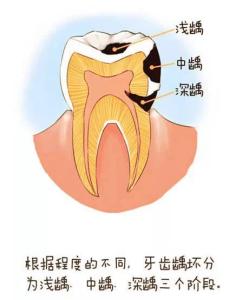 预防龋齿的措施 龋齿是如何形成的