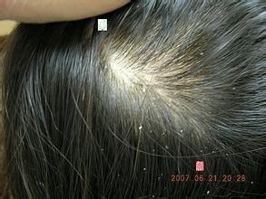 头皮屑多是什么原因 头皮屑 头皮屑多的原因及治疗