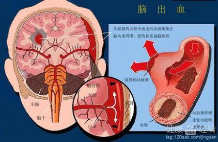 喝酒可诱发脑出血吗 脑出血后遗症 脑出血后遗症的诱发因素