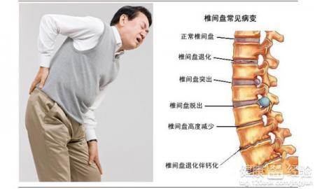 腰椎病 腰间盘突出 腰间盘突出怎么治 腰椎间盘突出调理五大注意点