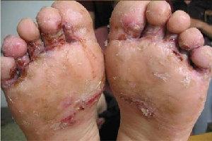 脚上起水泡是什么原因 引起脚气的原因有哪些