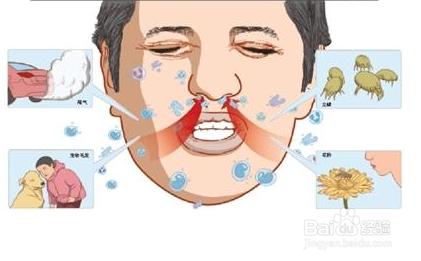 过敏性鼻炎用什么药 过敏性鼻炎如何治疗