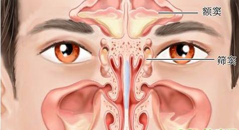 鼻窦炎症状及治疗方法 鼻窦炎的症状及治疗 鼻窦炎的治疗方法