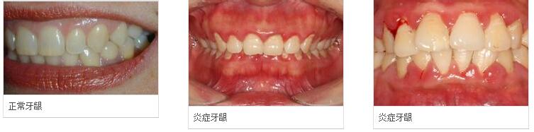 牙龈炎和牙周炎图片 牙龈炎如何治疗