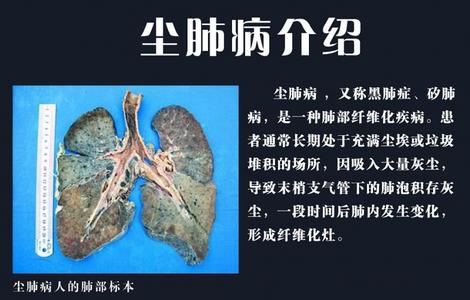 尘肺病的治疗方法 尘肺病 尘肺病如何治疗